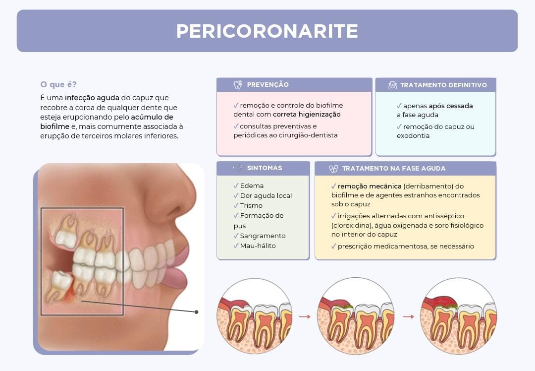Cirurgia de Siso e Pericoronarite